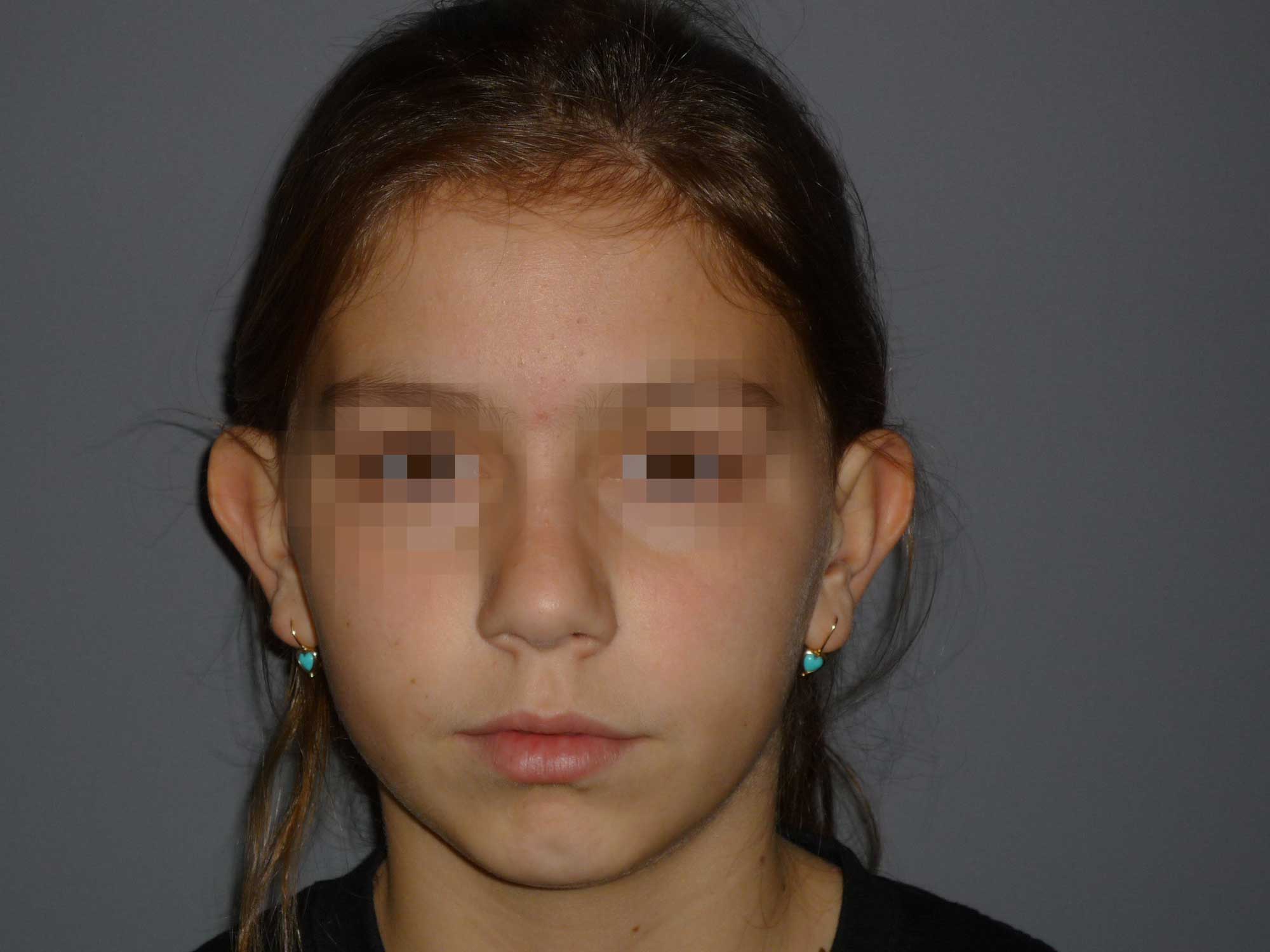 Vorher